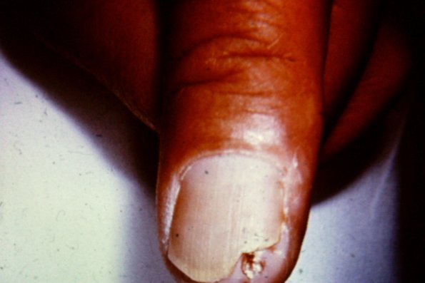 Keratoacanthoma Of Nailbed