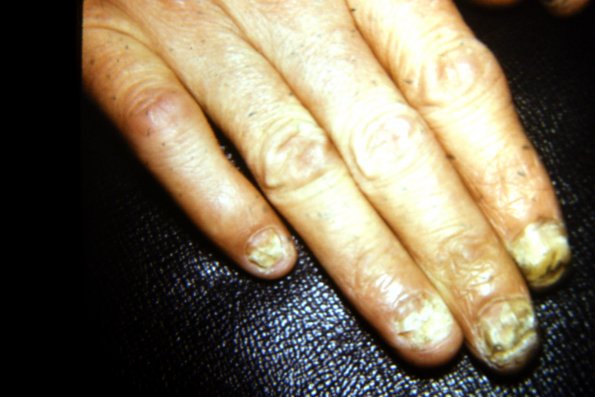 Tinea Of Nails