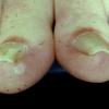 Pincer Nail Dystrophy