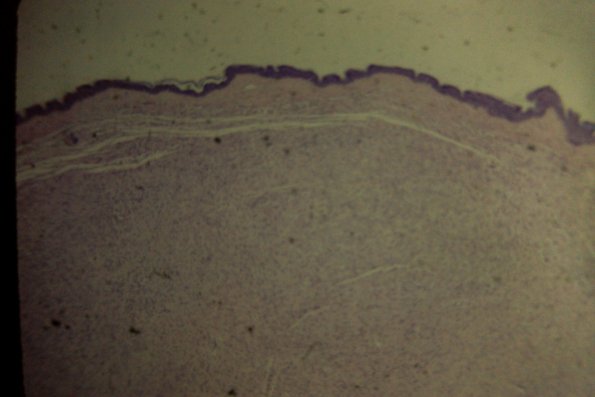 Neurofibroma (12)