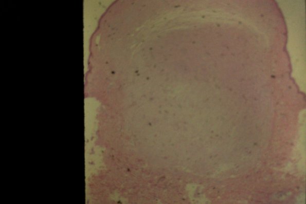 Neurofibroma (5)