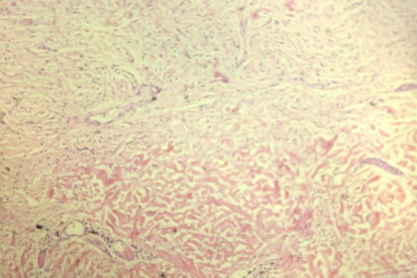Neurofibroma (7)