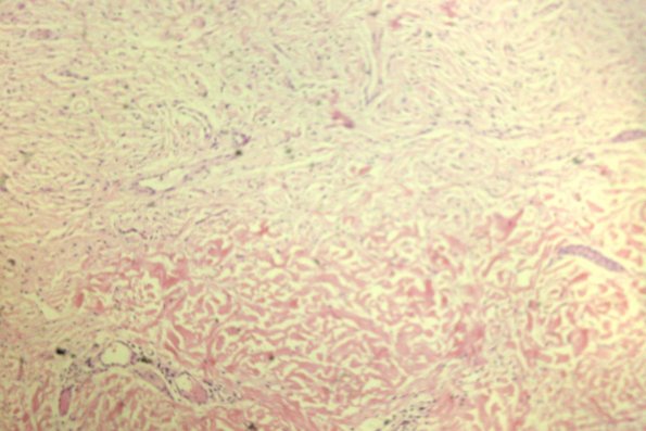 Neurofibroma (7)