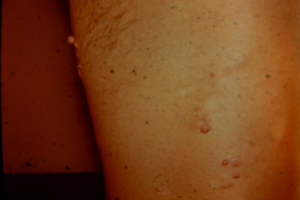 Neurofibroma (9)