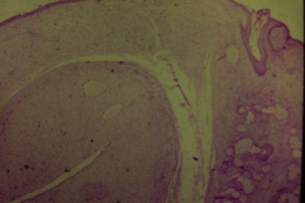 Neurofibrosarcoma