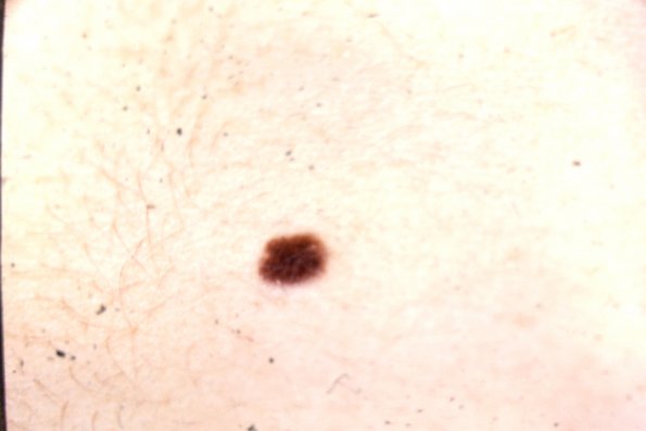 Compd. Nevus