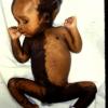 Congenital  Full Body Nevus