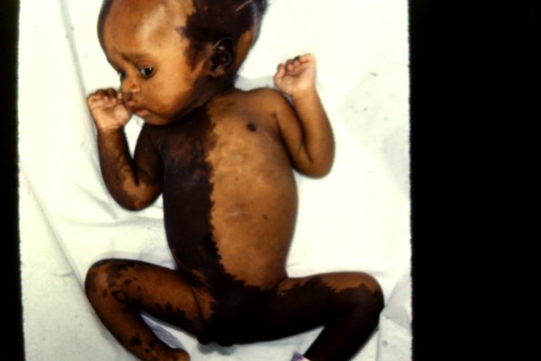 Congenital  Full Body Nevus