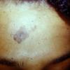 Epidermal Nevus (4)