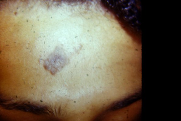 Epidermal Nevus (4)