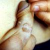 Epidermal Nevus