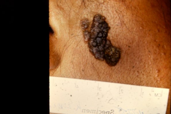 Verrucous Epid Nevus (3)