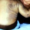 Verucous Epidermal Nevus