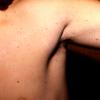 Nevus Comedonicus (2)