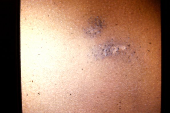 Nevus Comedonicus (7)