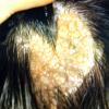 Nevus Sebaceous (4)