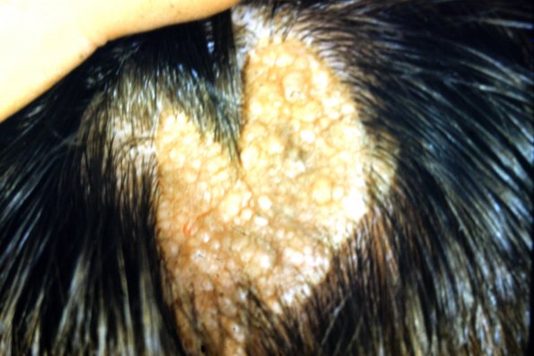 Nevus Sebaceous (4)