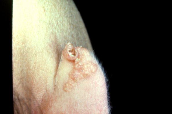 Nevus Sebaceous