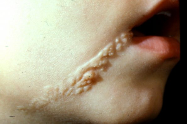 Nevus sebaceous Organoid Nevus (2)