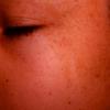 Nevus Spilus (3)