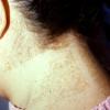 Speckled Lentighams Nevus