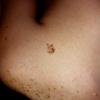 Speckled Lentigirous Nevus