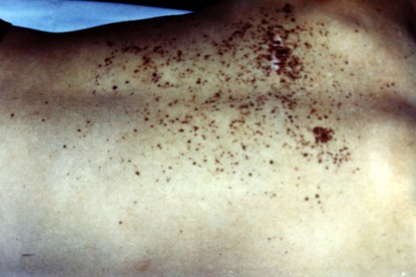 Speckled Nevus