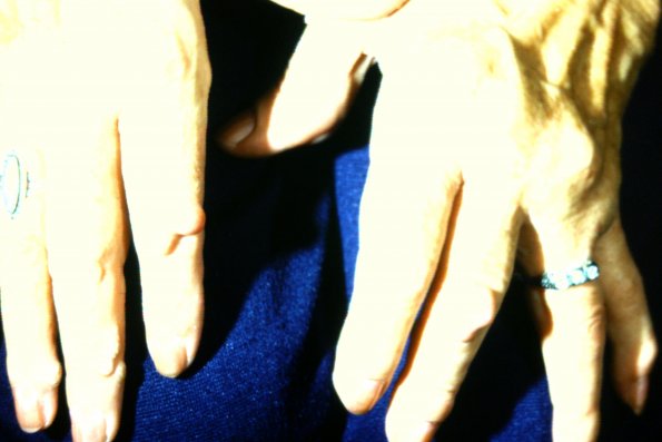 Rheumatoid Nodules+ Verrucae