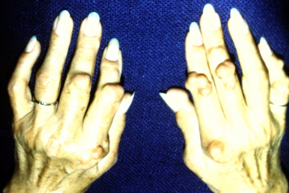 Rheumatoid Nodules