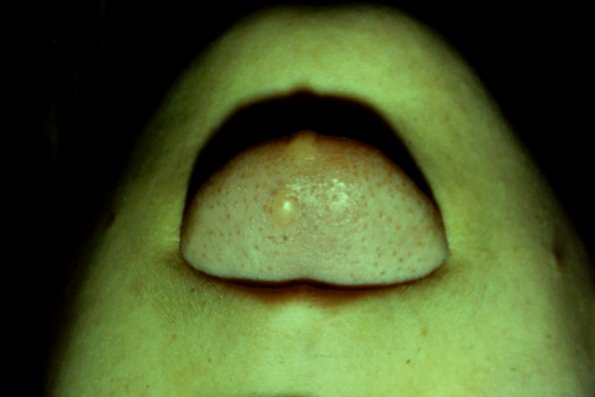 Fibroma of tongue