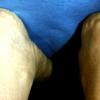 Painful Piezogenic Papules Heels (2)