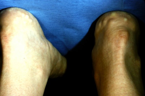 Painful Piezogenic Papules Heels (2)
