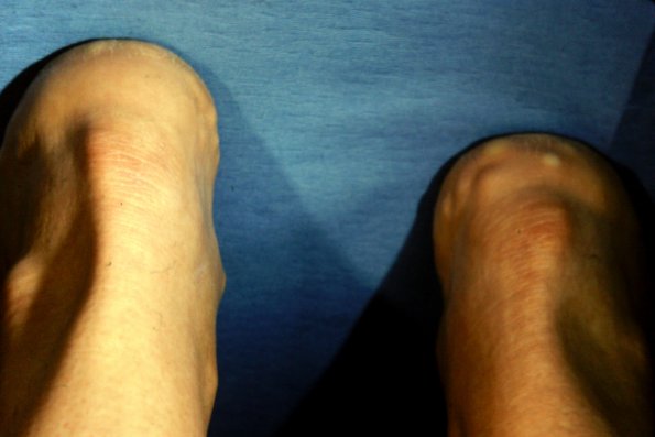 Painful Piezogenic Papules Heels