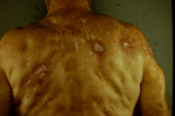 Lupus Panniculitis (2)