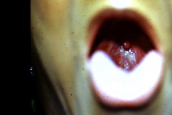 Cicatricial Pemphigus (2)