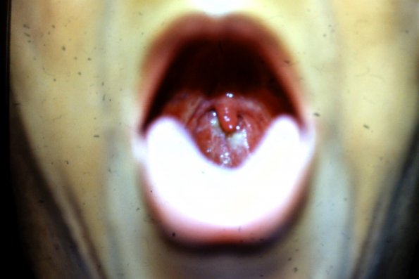 Cicatricial Pemphigus