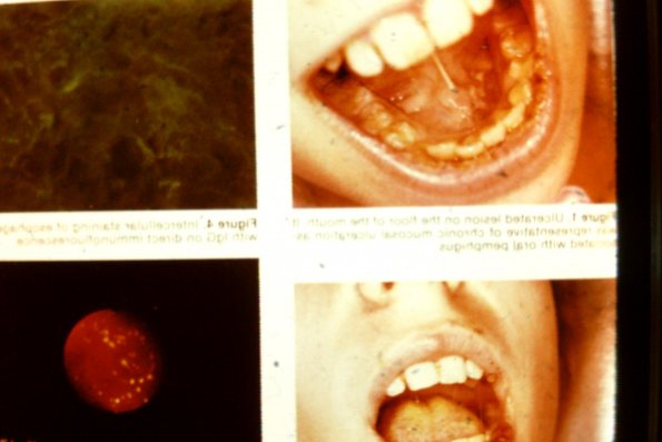 Oral Pemhigus