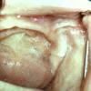 Oral Pemphigus (2)