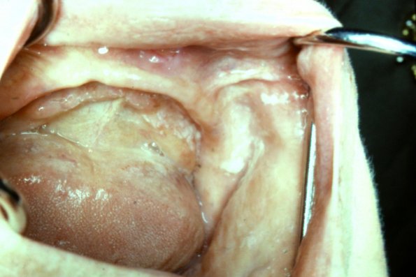 Oral Pemphigus (2)