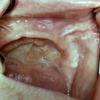 Oral Pemphigus
