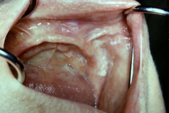 Oral Pemphigus