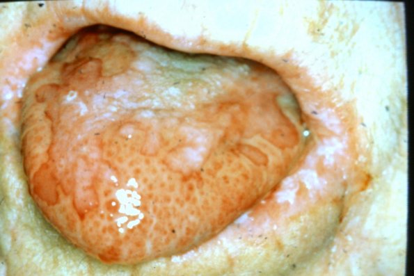 Paraneoplastic Pemphigus (4)