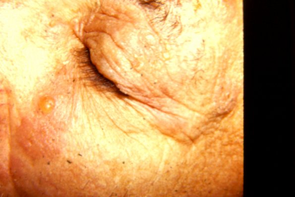 Pemphigoid (2)