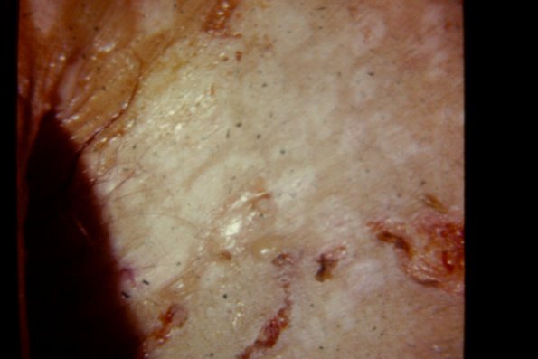 Pemphigoid (4)