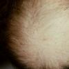 Pemphigold-Brunsting Perry type Causing Alopecia (2)