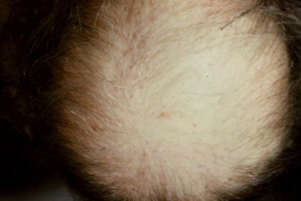 Pemphigold-Brunsting Perry type Causing Alopecia (2)