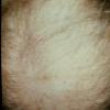 Pemphigold-Brunsting Perry type Causing Alopecia