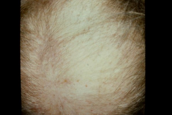 Pemphigold-Brunsting Perry type Causing Alopecia