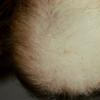 Pemphigold-Brunsting-Perry Type Causing Alopecia