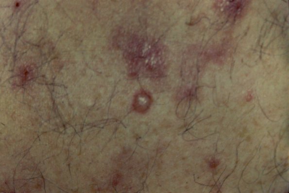 Pemphigus (2)